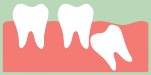What is a wisdom tooth 300x150