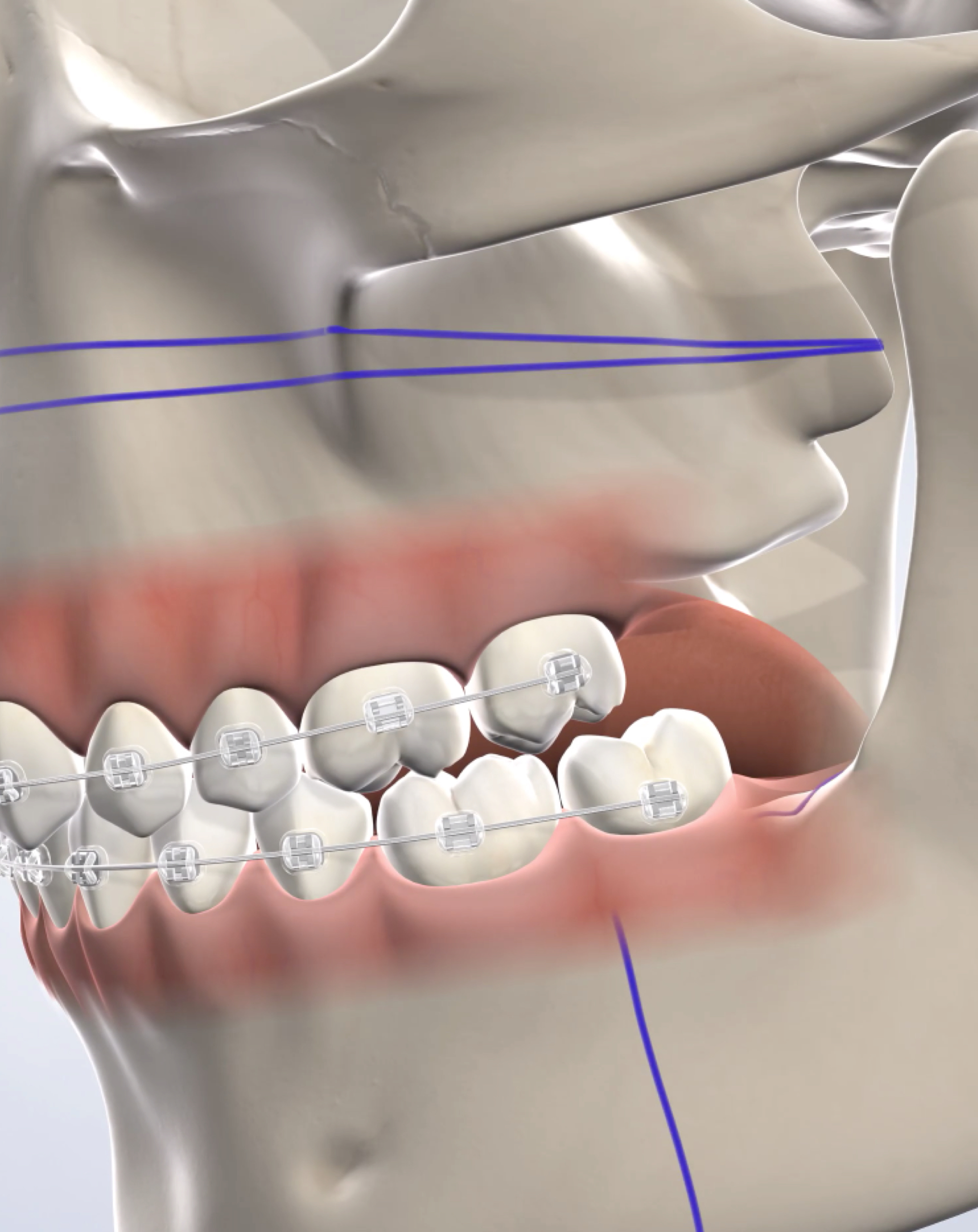 Jaw Surgery in Feasterville, Newtown, and Abington, PA