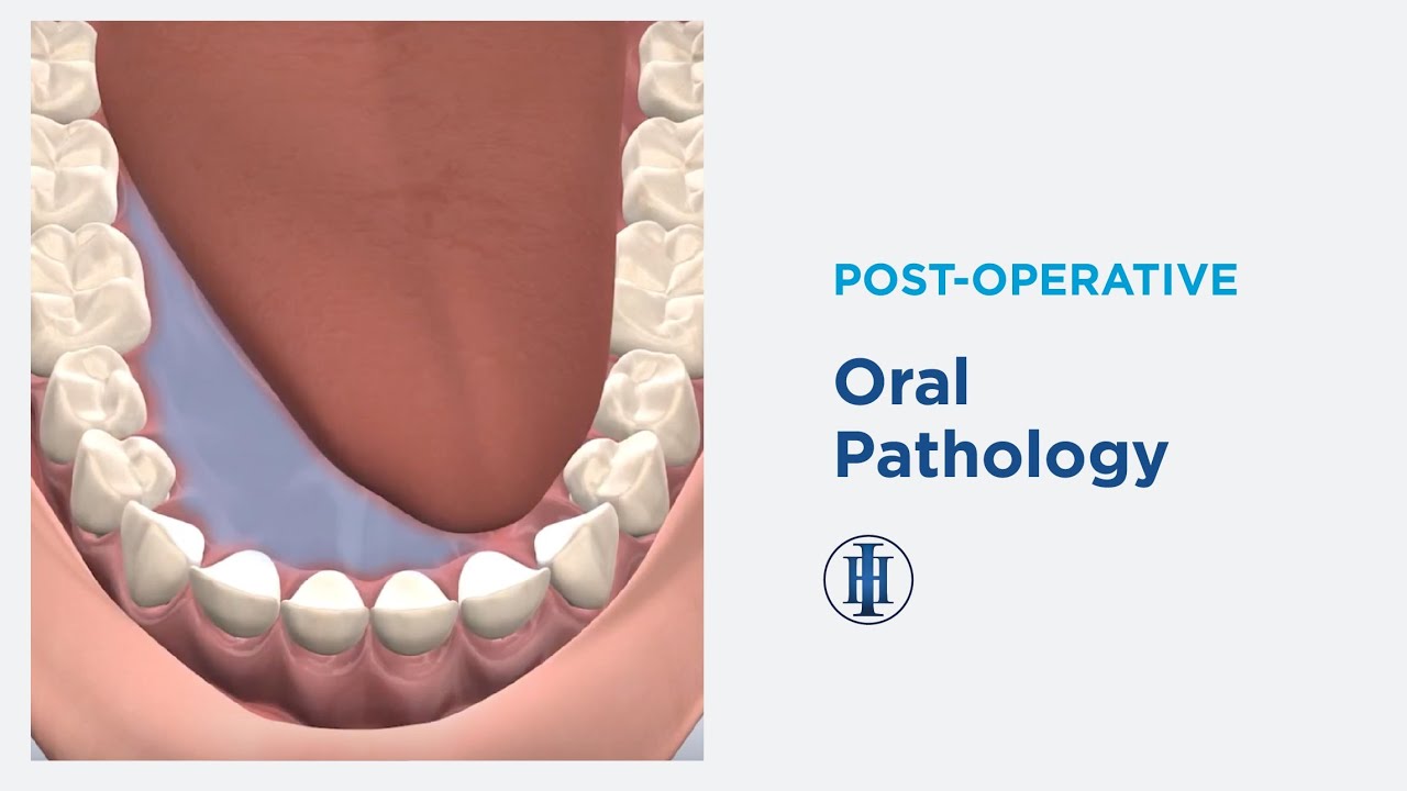 Post op oral pathology instructions