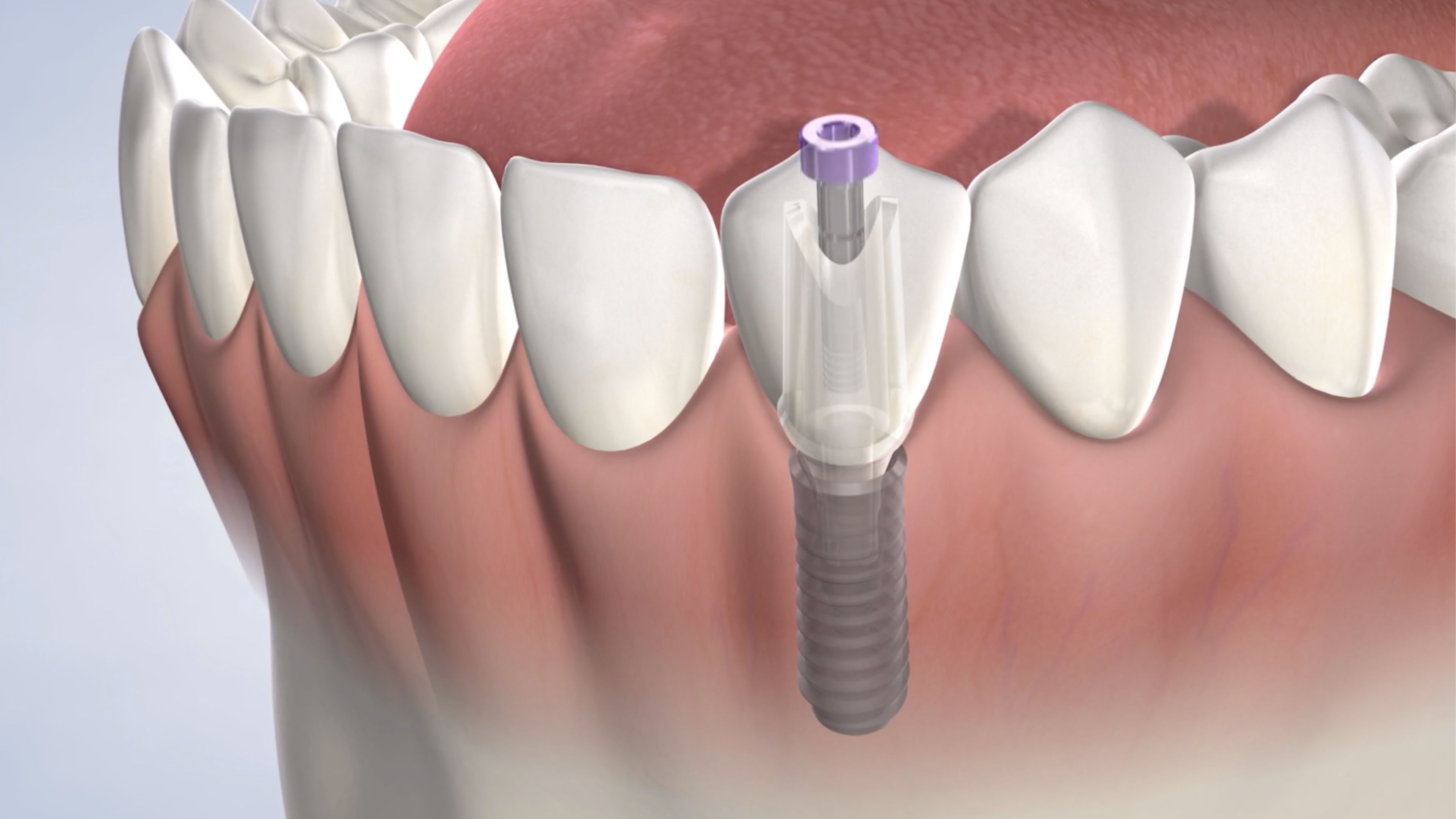 Instruction  dental implant
