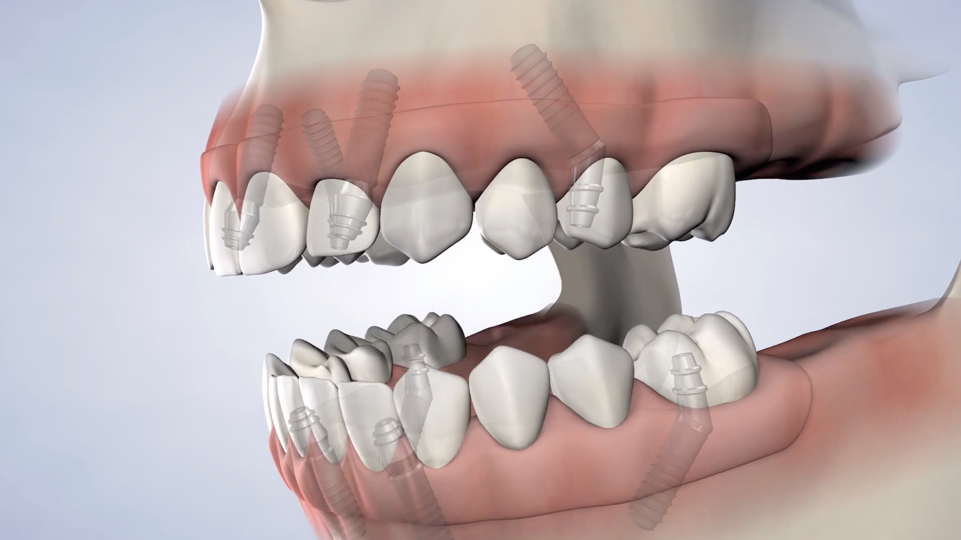 Instruction  full arch