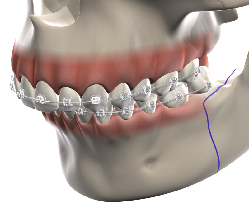 Isolated  jaw surgery  mobile