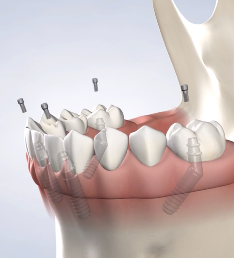 Full-Arch restoration in Reno and Sparks, Nevada