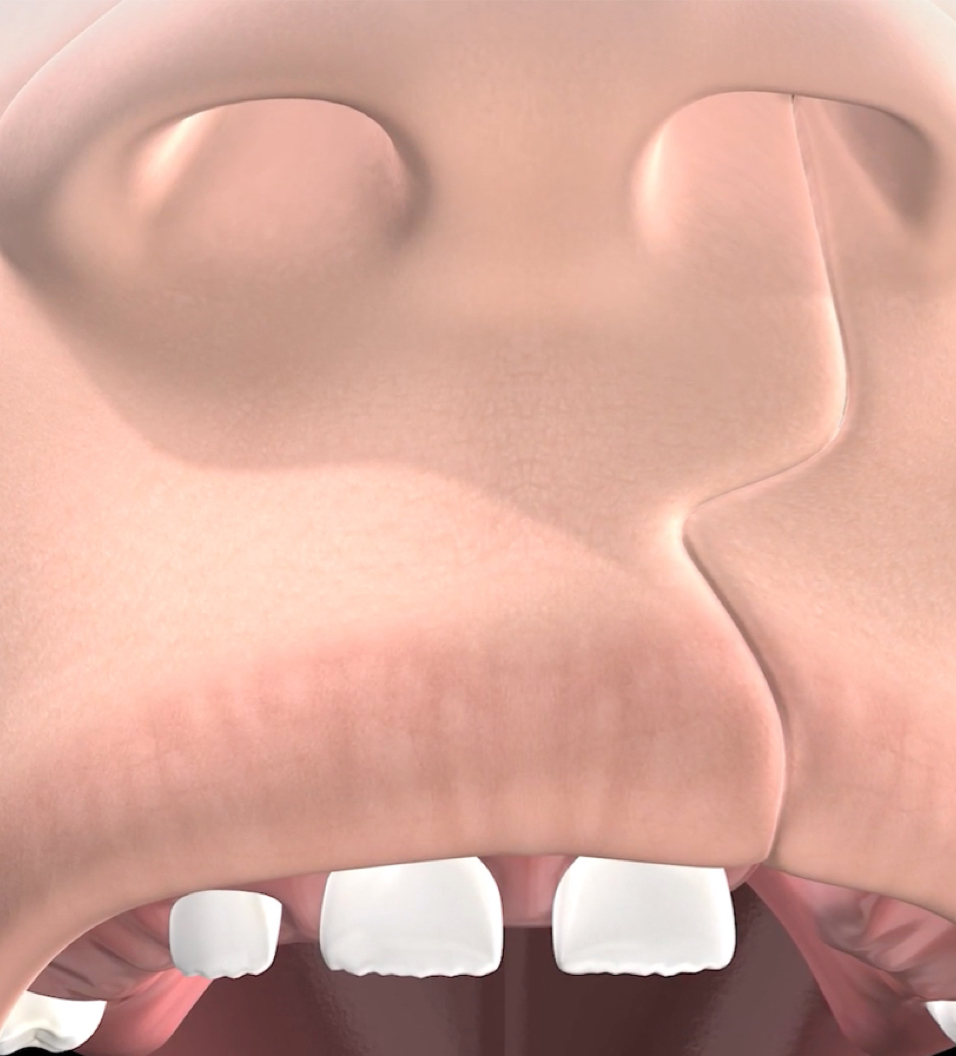 Cleft lip repair in Reno and Sparks, Nevada