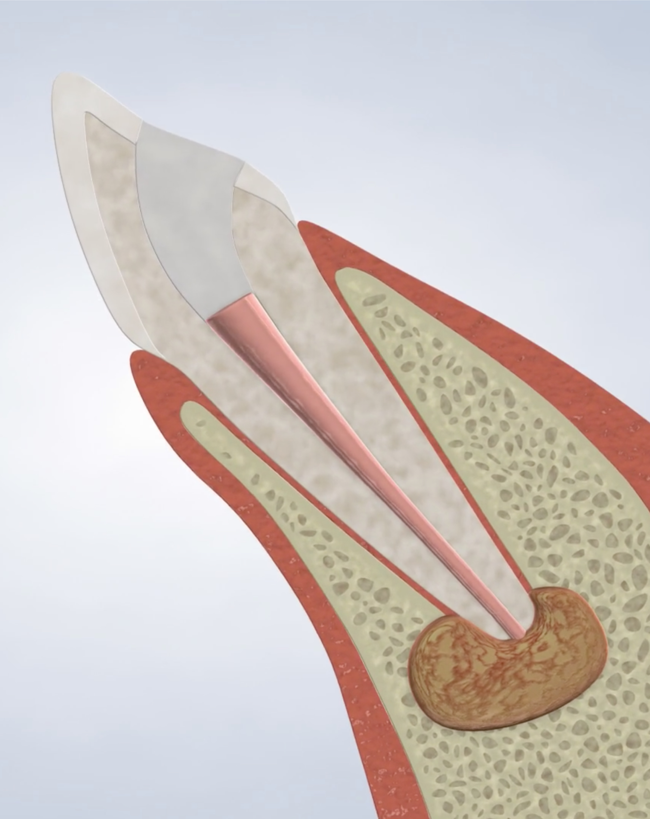 Apicoectomy procedure mobile.jpg