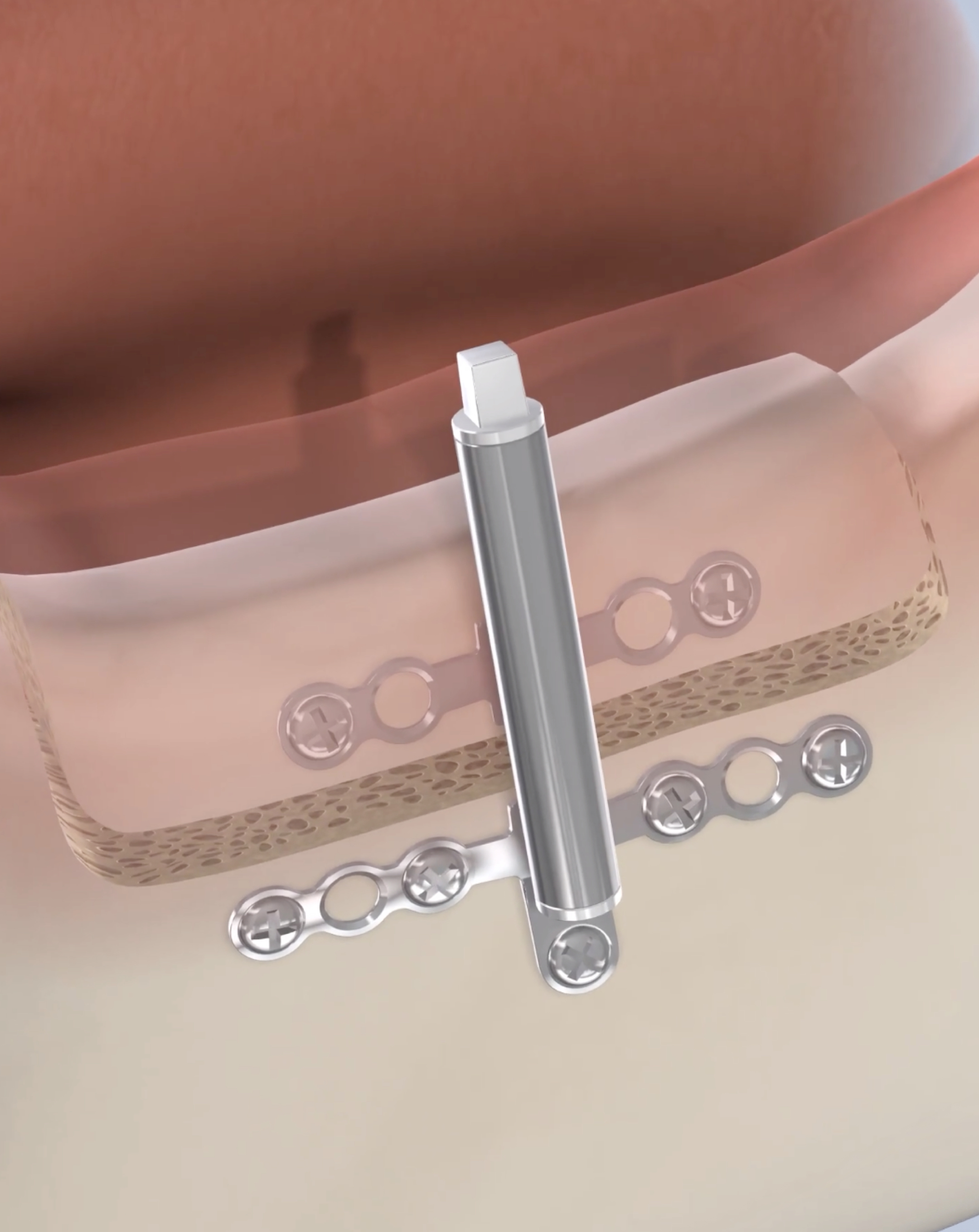 Distraction osteogenesis procedure mobile.jpg