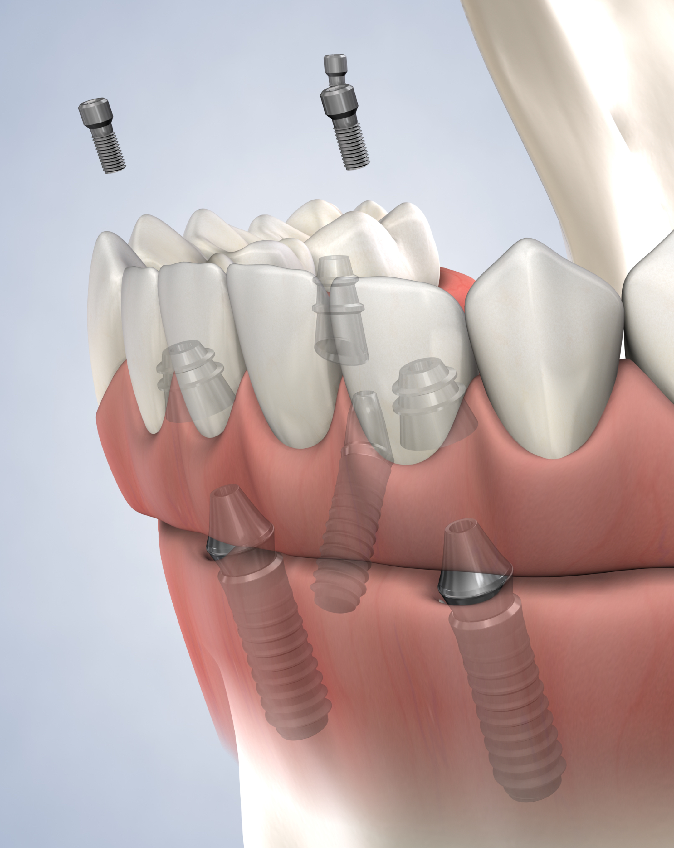 Full arch restoration procedure mobile.jpg
