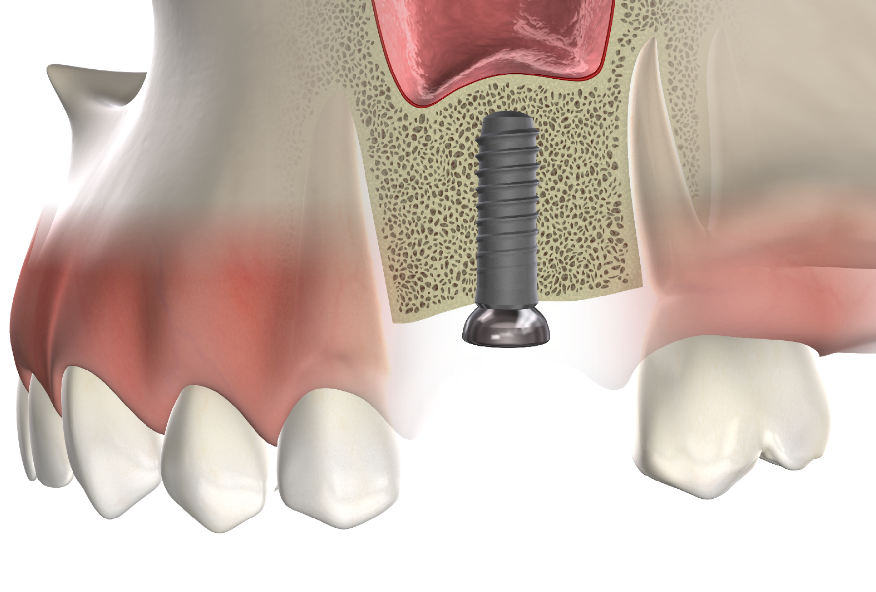 isolated  bone grafting