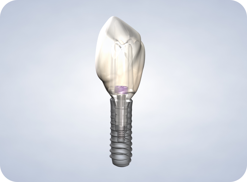 Advanced dental implants