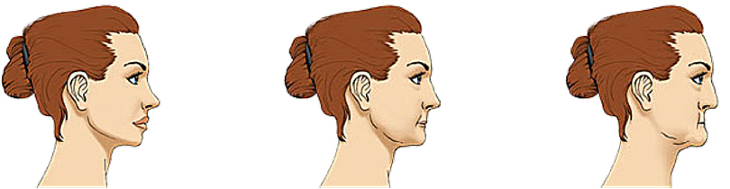 Smile complete bone loss prevention