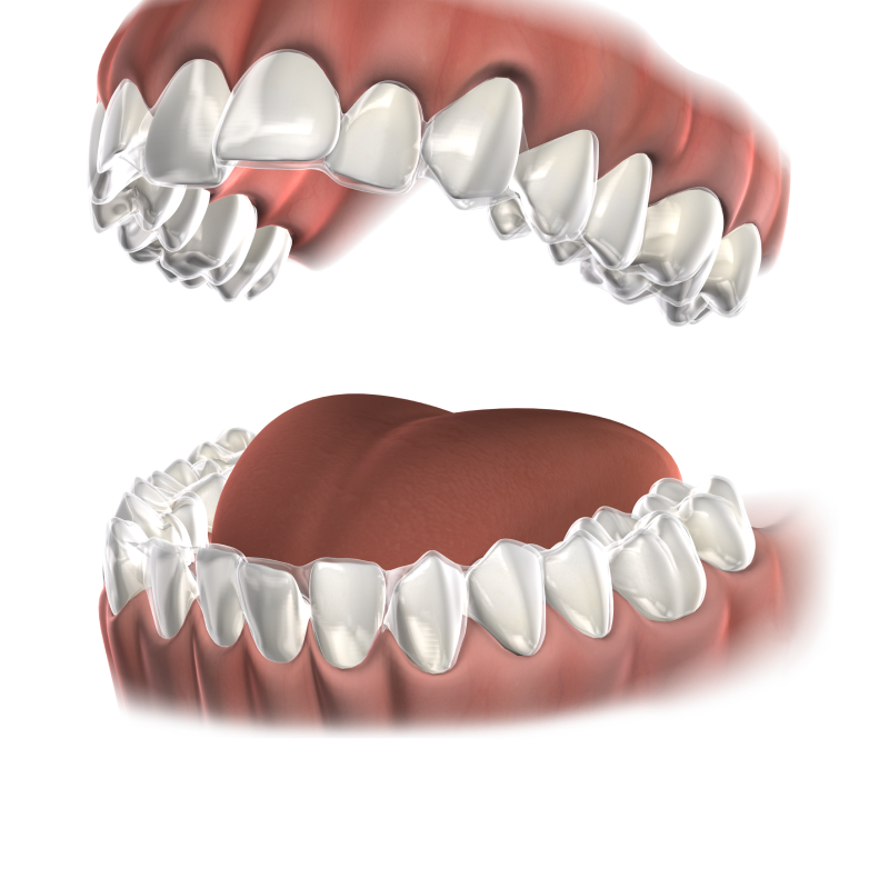 isolated  invisalign  mobile