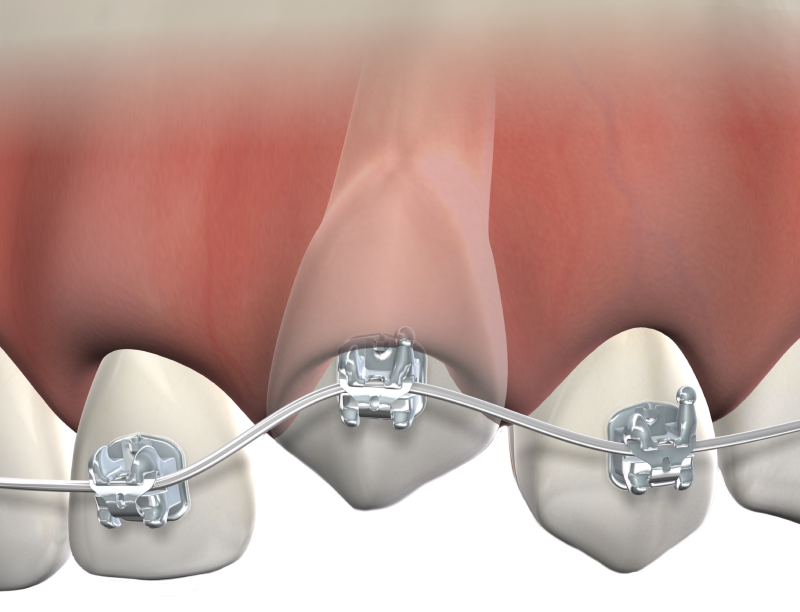 Isolated  impacted tooth  mobile