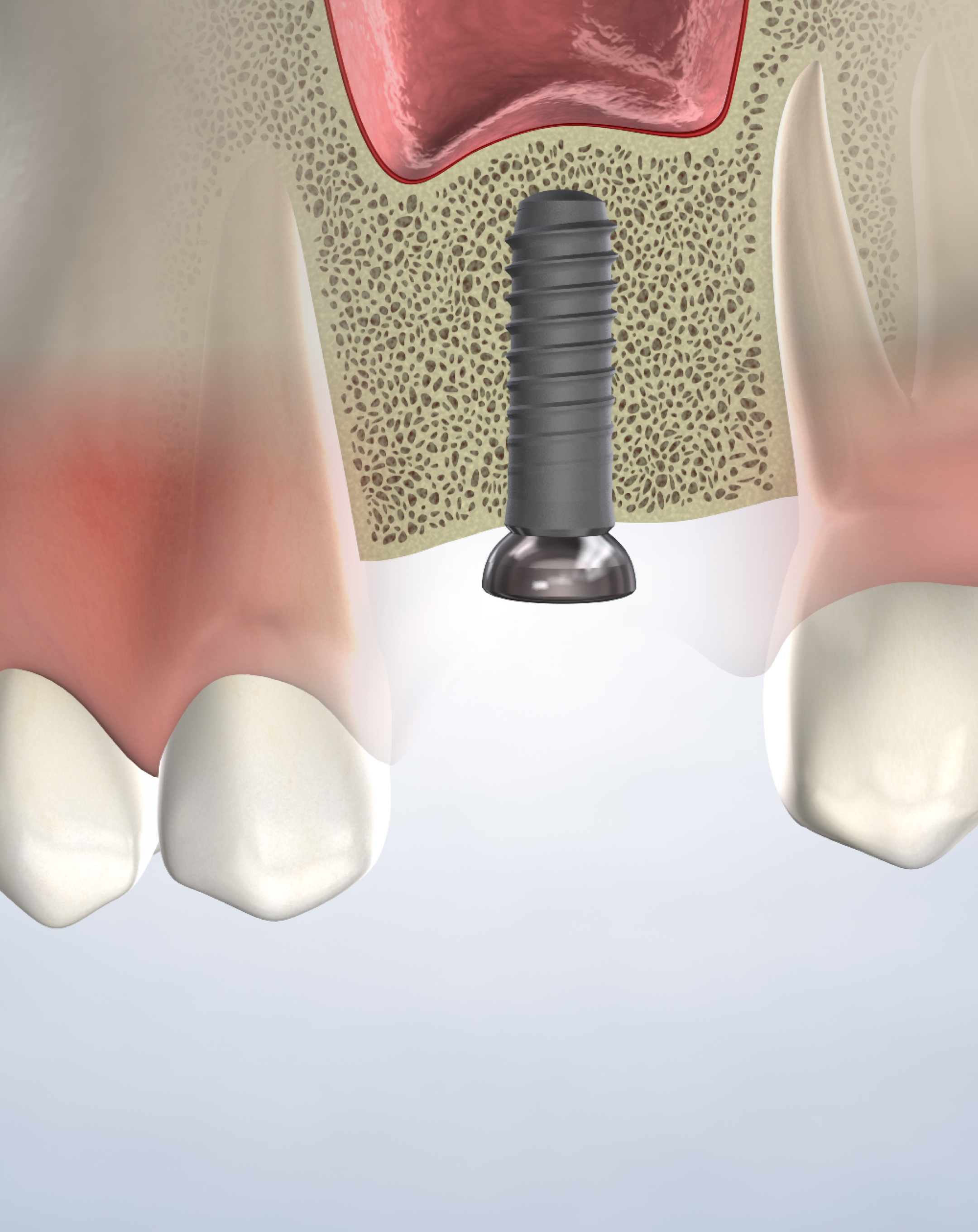 Procedure hero mobile bone grafting.jpg