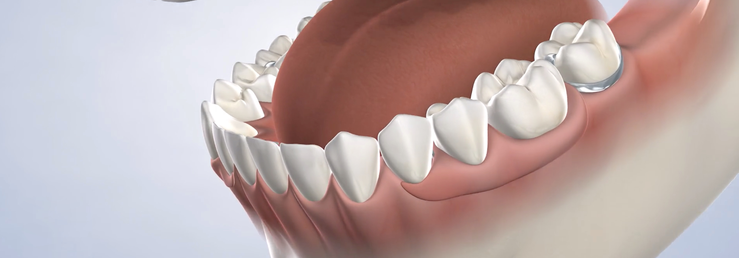 Tooth replacement options in Sonoma and Napa, CA