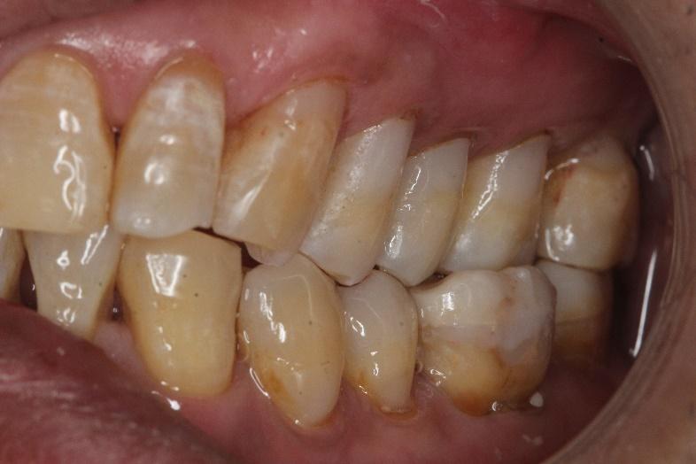 Composites tooth color fillings  after