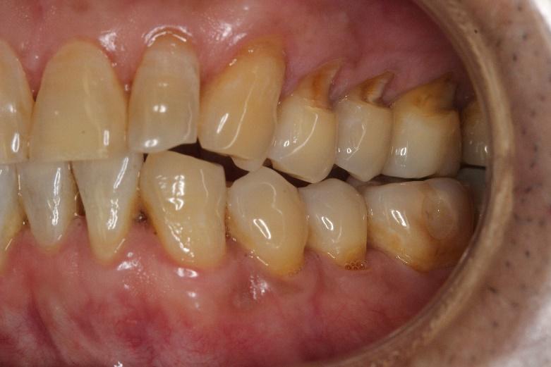 Composites tooth color fillings  before