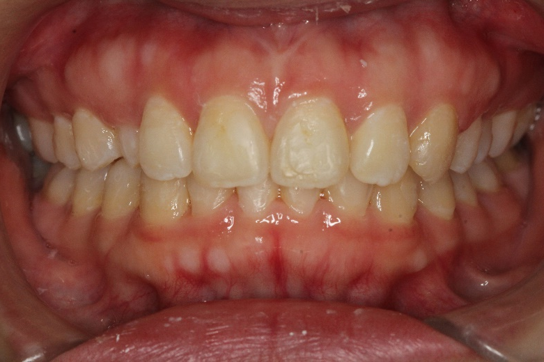 Invisalign  after