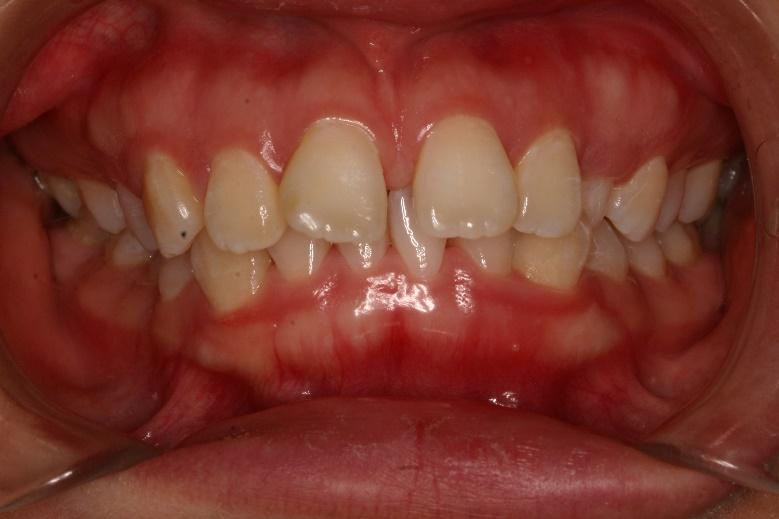 Invisalign  before
