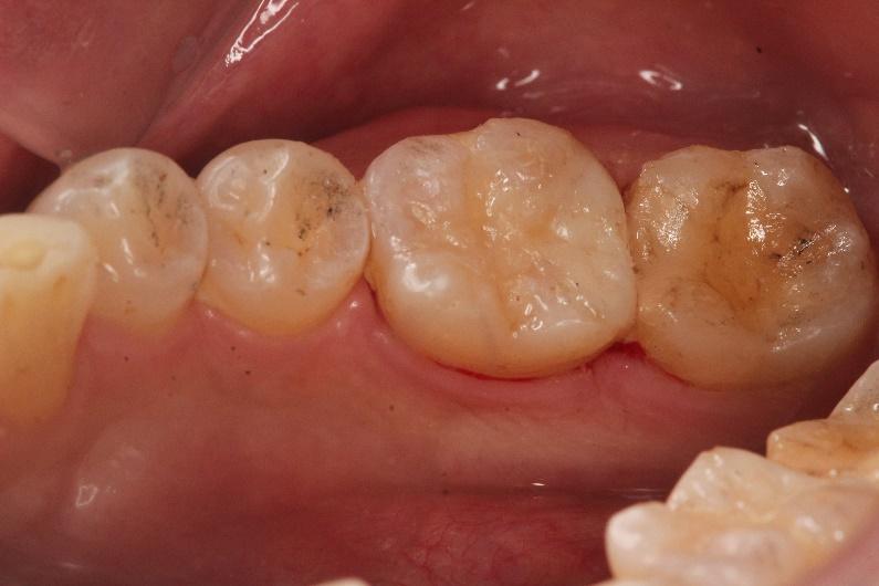 Porcelain inlay  after