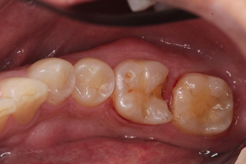 Porcelain inlay  before