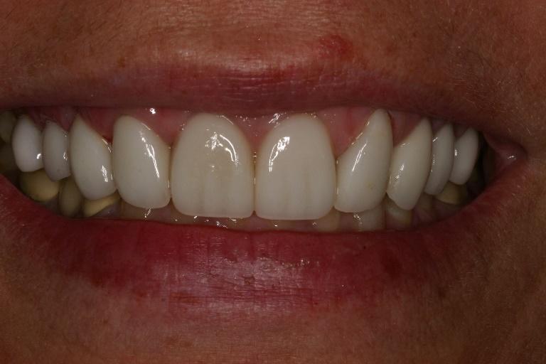 Porcelain veneers  after