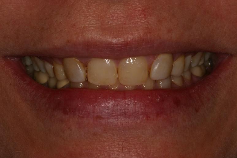 Porcelain veneers  before