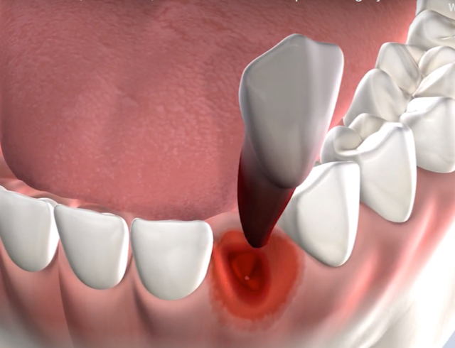 Tooth extraction procedure query page
