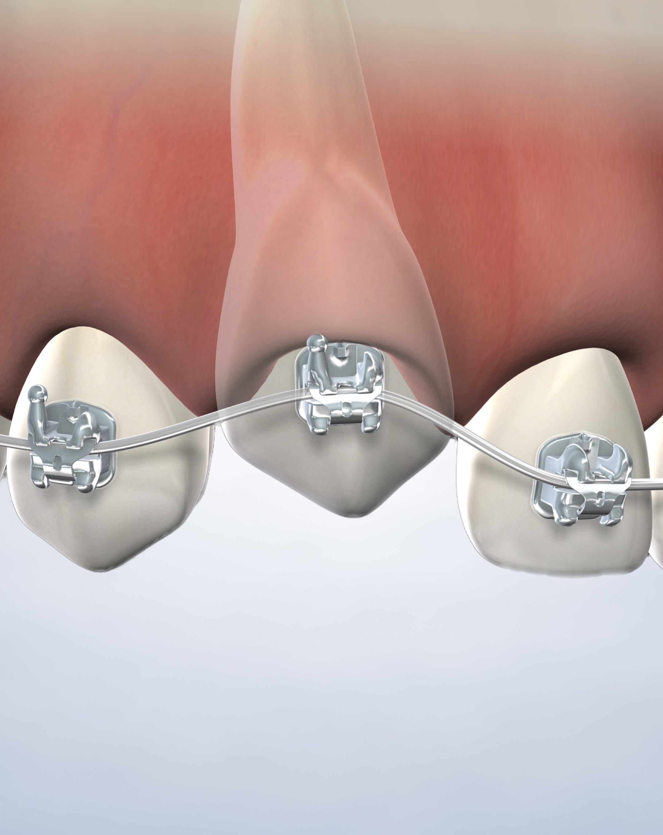 Impacted tooth exposure in South Jordan, Provo, Payson, and Lehi, Utah