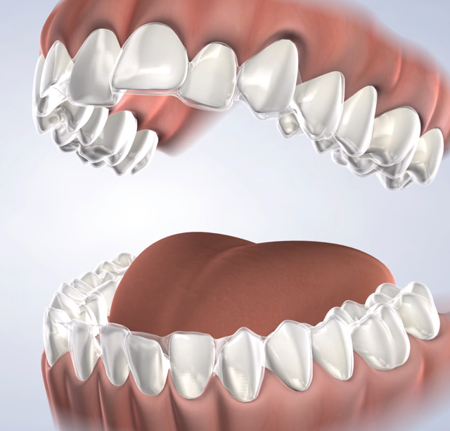 Teeth whitening in Lehi, UT