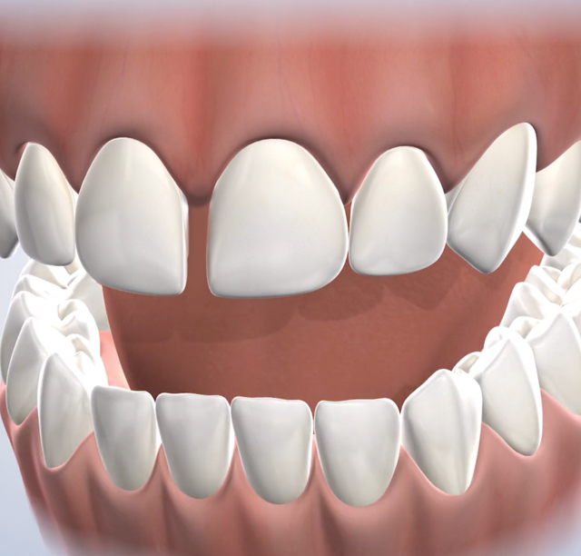 Dental bonding in Lehi, UT