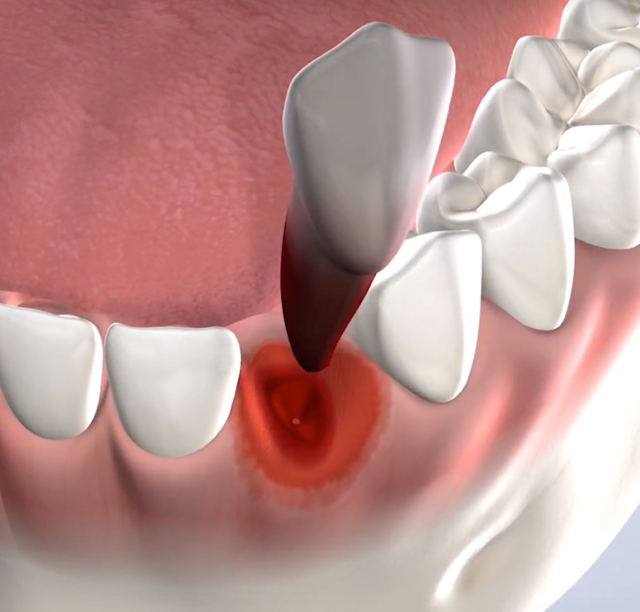 Tooth extractions in Lehi, UT