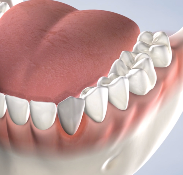 Tooth fillings in Lehi, UT