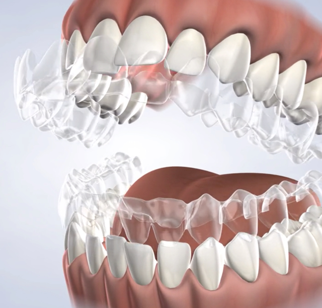 Invisalign in Lehi, UT
