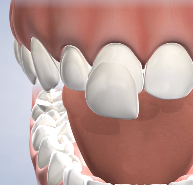 Veneers in Lehi, UT