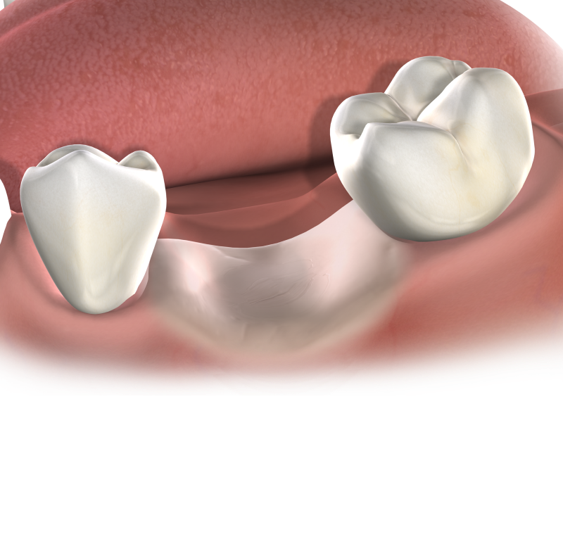 Bone resorption banner mobile