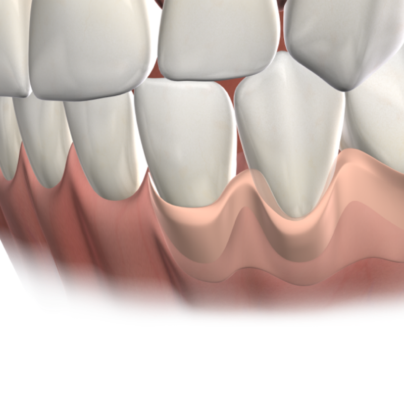 Gum grafting banner mobile