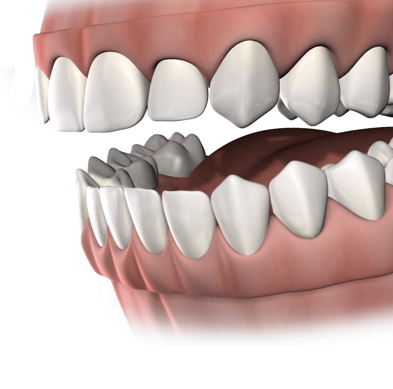 Implant supported dentures banner mobile