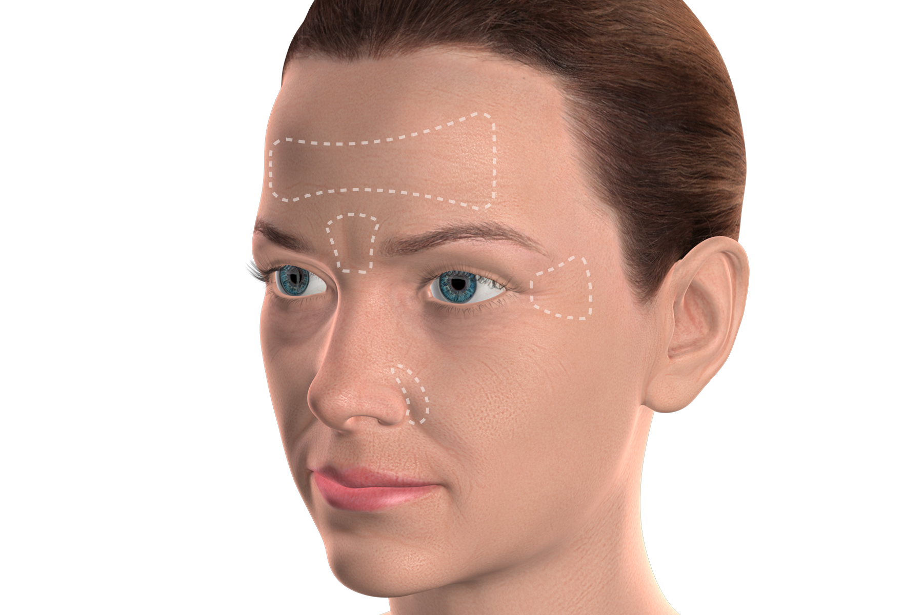 Isolated  botox for tmj
