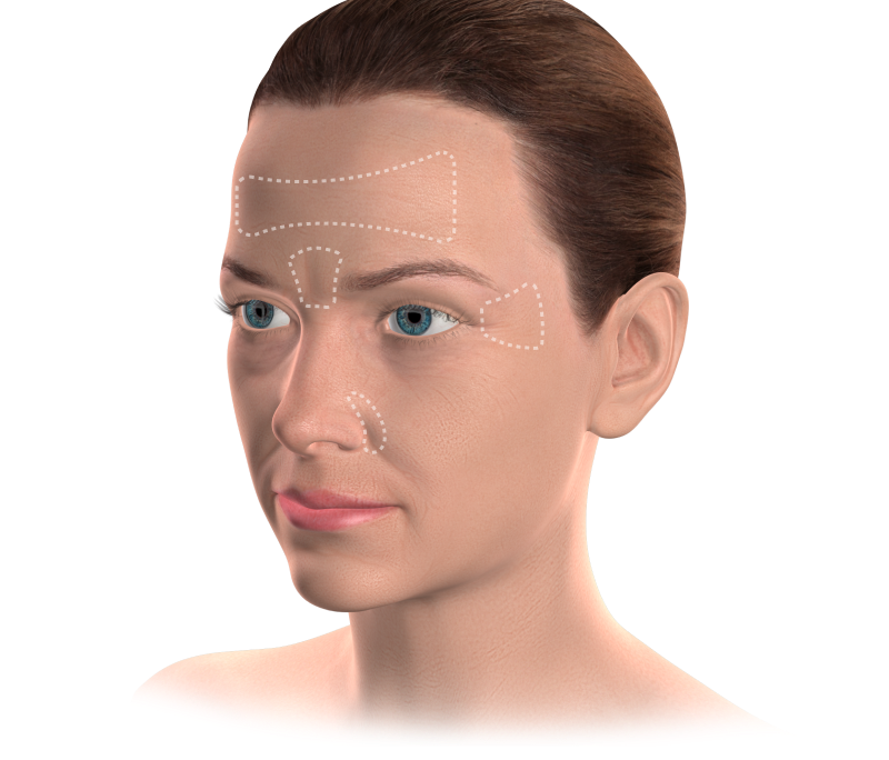 Isolated  botox for tmj mobile