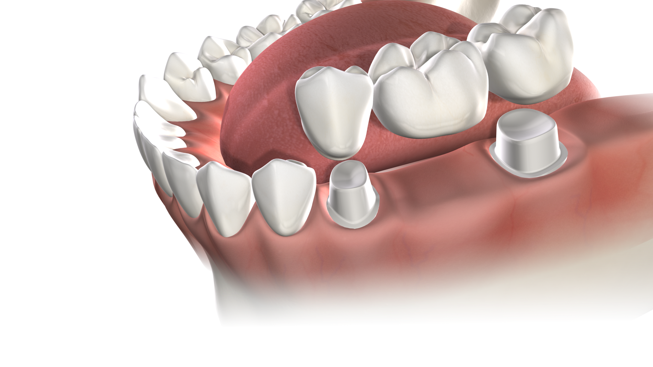 Multiple teeth replacement banner desktop