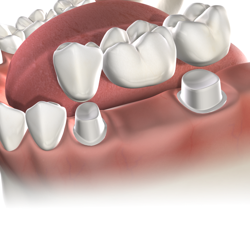 Multiple teeth replacement banner mobile