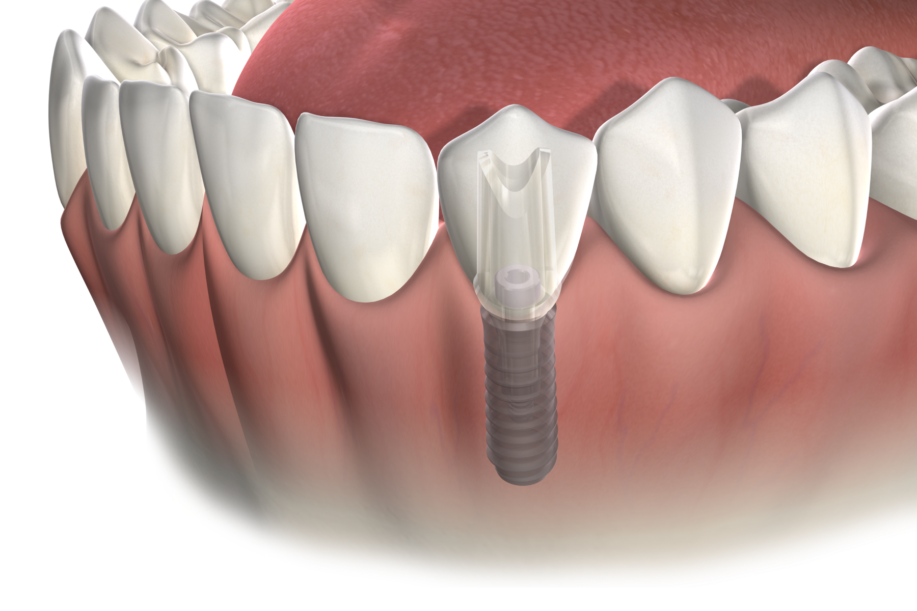 Single tooth replacement banner desktop