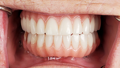 Implant surgery case 1 after 2