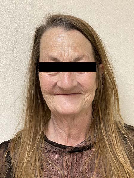 Implant surgery case 1 before 1