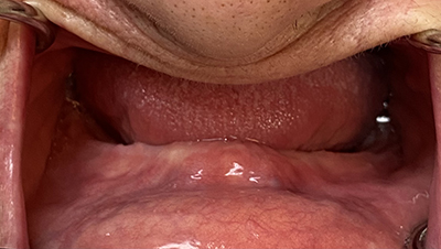 Implant surgery case 1 before 2