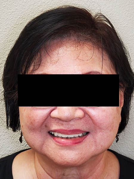 Implant surgery case 2 after 1