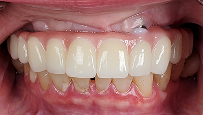 Implant surgery case 2 after 2