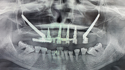 Implant surgery case 2 after 3