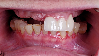 Implant surgery case 2 before 2