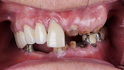 Implant surgery case 3 before 2